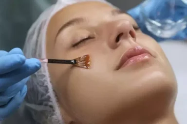 Chemical-Peel