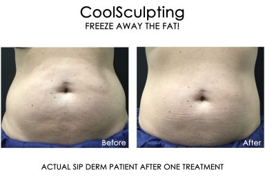 coolsculpting24rev-1-scaled